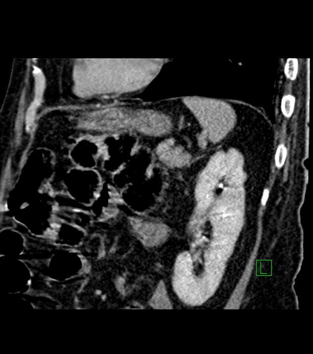 Cholangiocarcinoma with cerebral metastases (Radiopaedia 83519-98629 Sagittal C+ delayed 33).jpg