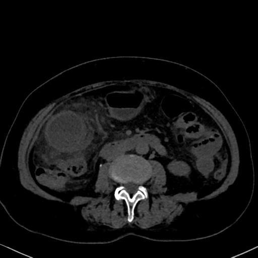 File:Cholecystitis - obstructive choledocholitiasis (CT intravenous cholangiography) (Radiopaedia 43966-47479 Axial 134).png