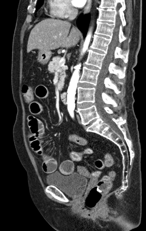 Cholecystoduodenal fistula due to calculous cholecystitis with gallstone migration (Radiopaedia 86875-103077 C 32).jpg