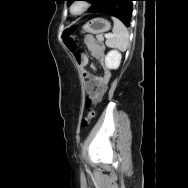 Choledocholithiasis on CT and MRI (Radiopaedia 24825-25087 D 49).jpg