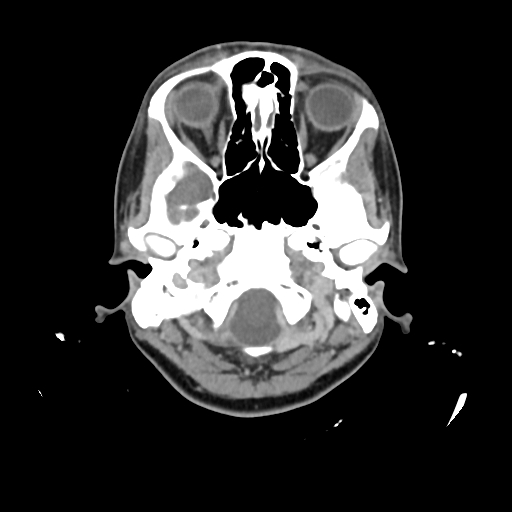 File:Chondroblastic osteosarcoma (Radiopaedia 67363-76741 Axial with contrast 37).jpg
