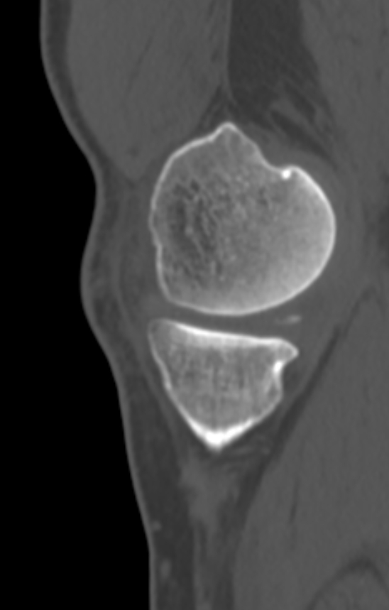 Chondrocalcinosis (Radiopaedia 82862-97173 Sagittal bone window 11).jpg