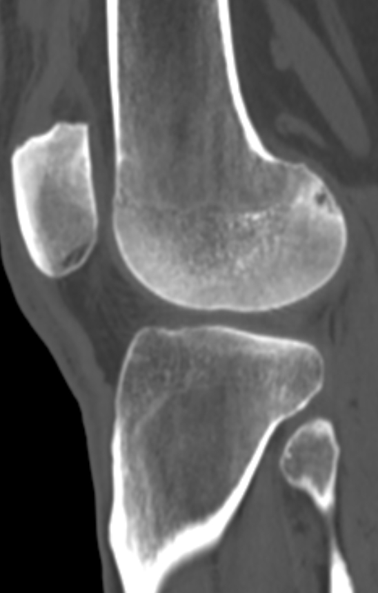 Chondrocalcinosis (Radiopaedia 82862-97173 Sagittal bone window 43).jpg