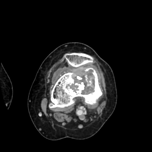 File:Chondrosarcoma - femur (Radiopaedia 64187-72954 Axial with contrast 41).jpg