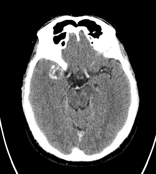 File:Chondrosarcoma of skull base- grade II (Radiopaedia 40948-43653 Axial Contrast 12).png