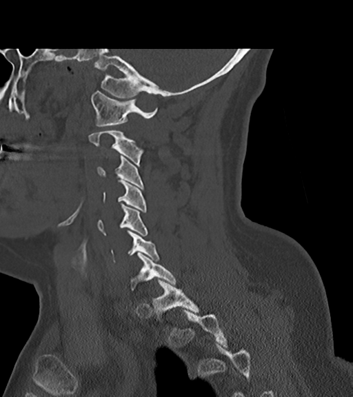 File:Chordoma (C4 vertebra) (Radiopaedia 47561-52188 Sagittal bone window 28).png