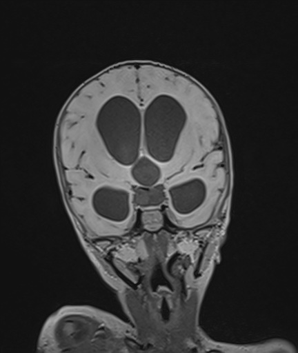 Choroid plexus papilloma (Radiopaedia 84612-100019 Coronal FLAIR 52).jpg