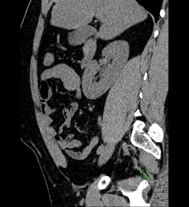 Chromophobe renal cell carcinoma (Radiopaedia 84286-99573 C 119).jpg