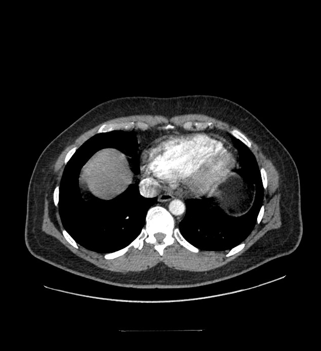 Chromophobe renal cell carcinoma (Radiopaedia 84337-99644 B 3).jpg