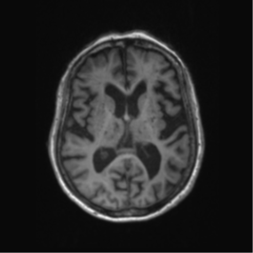 Chronic hypertensive encephalopathy (Radiopaedia 72844-83495 Axial T1 35).png