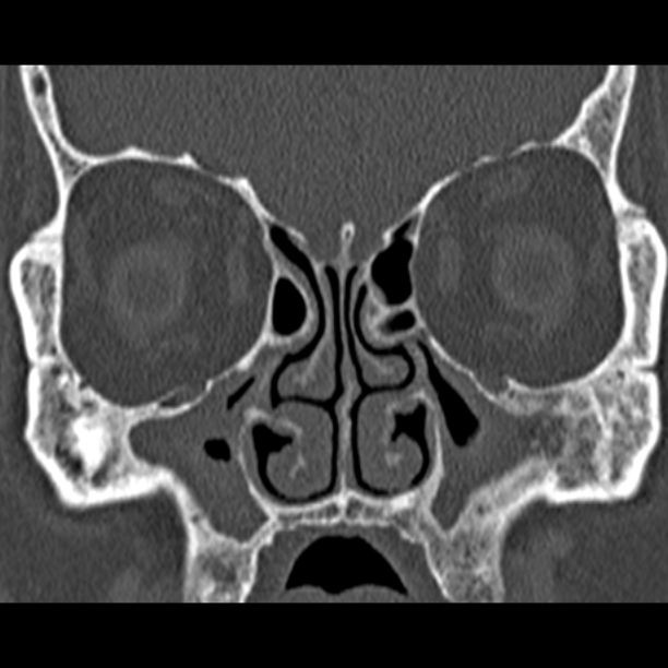 Chronic maxillary sinusitis (Radiopaedia 27879-28116 Coronal bone window 22).jpg