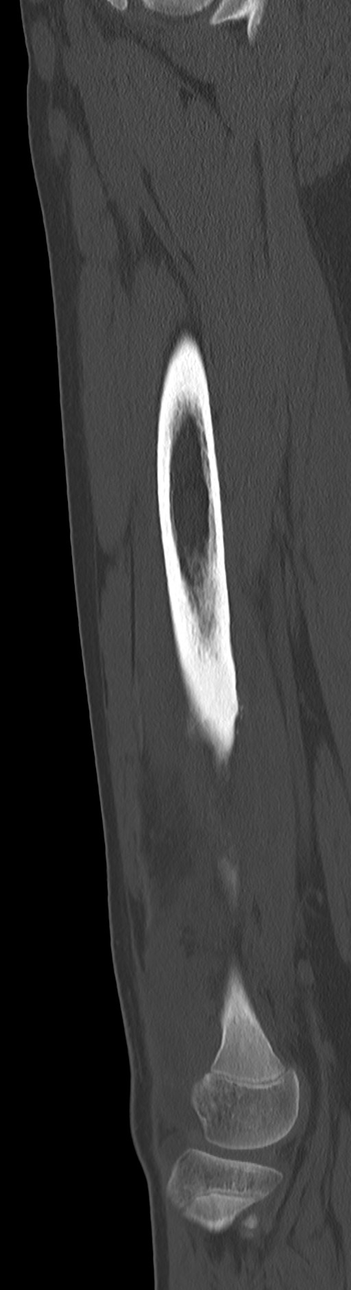 Chronic ostemyelitis of the femur with long sinus tract (Radiopaedia 74947-85982 Sagittal bone window 43).jpg