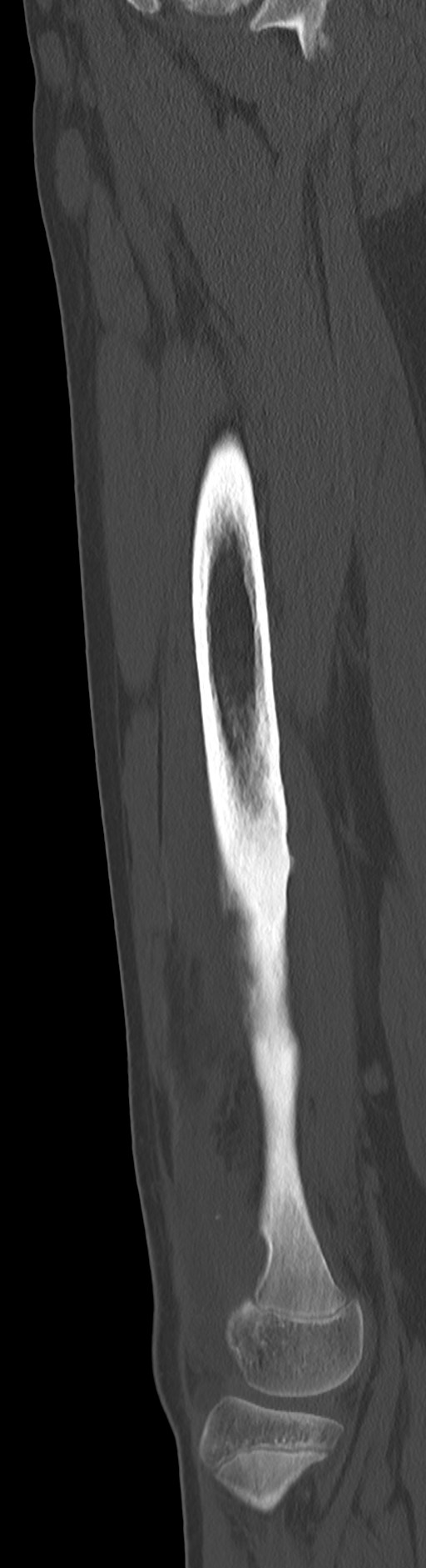 Chronic ostemyelitis of the femur with long sinus tract (Radiopaedia 74947-85982 Sagittal bone window 44).jpg