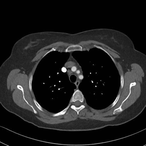 Chronic pulmonary embolus (Radiopaedia 39129-41341 Axial C+ CTPA 30).png