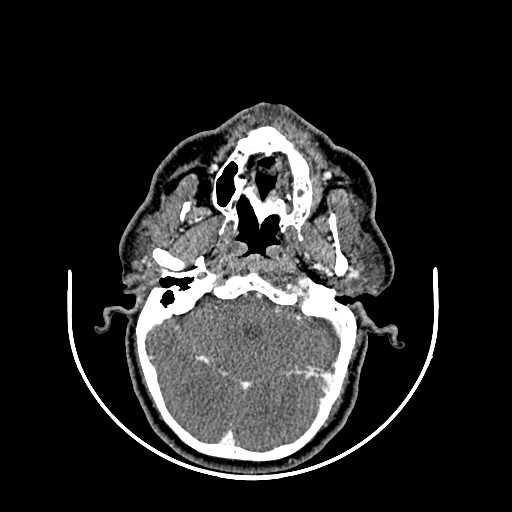 File:Chronic submandibular abscess (Radiopaedia 21738-21718 A 2).jpg