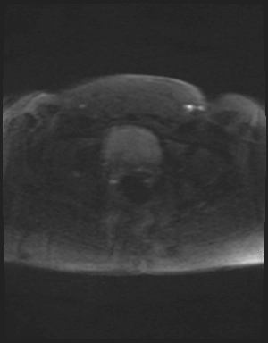 File:Class II Mullerian duct anomaly- unicornuate uterus with rudimentary horn and non-communicating cavity (Radiopaedia 39441-41755 Axial DWI 86).jpg