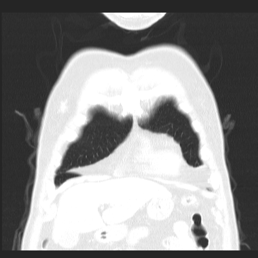 File:Classic complicated silicosis (Radiopaedia 49720-54961 Coronal lung window 5).jpg