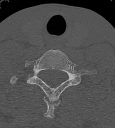 Clay-shoveler fracture (Radiopaedia 14604-14532 Axial bone window 32).jpg