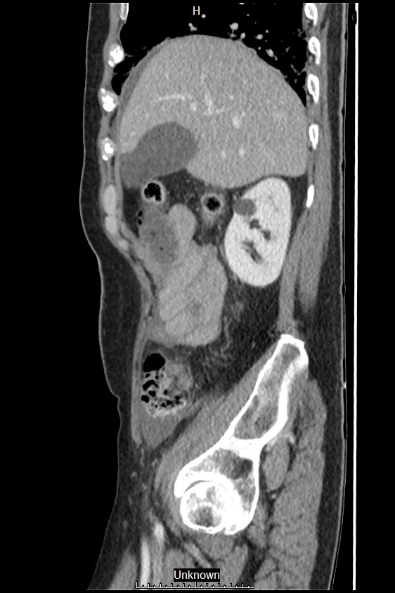 Closed loop bowel obstruction and ischemia (Radiopaedia 86959-103180 C 51).jpg