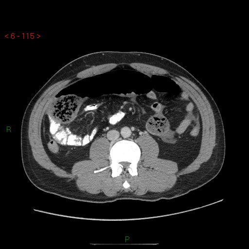 File:Closed loop obstruction and appendicular stump mucocele (Radiopaedia 54014-60163 A 65).jpg