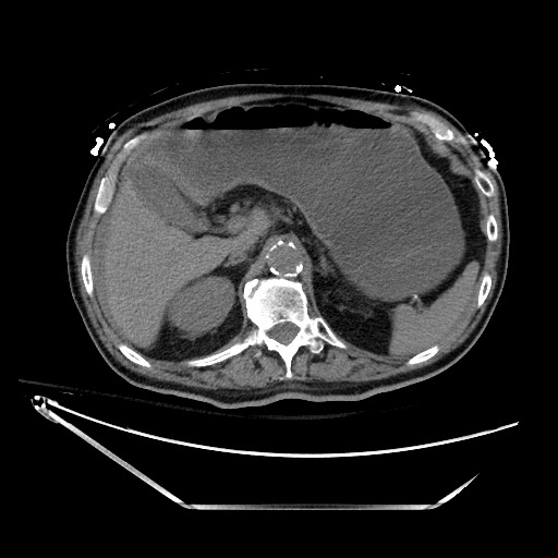 File:Closed loop obstruction due to adhesive band, resulting in small bowel ischemia and resection (Radiopaedia 83835-99023 Axial non-contrast 44).jpg