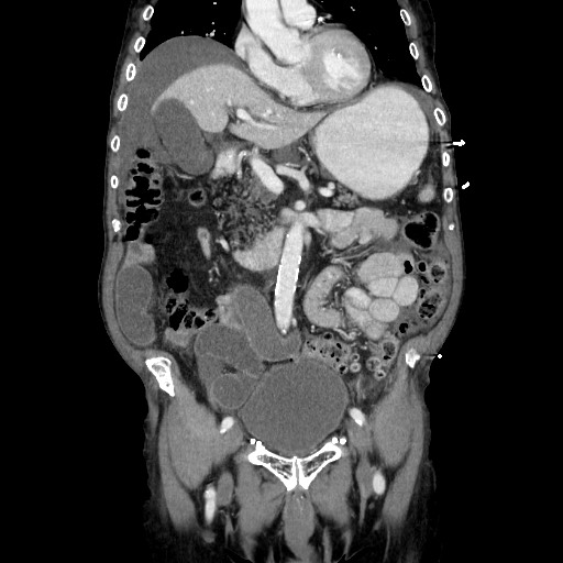 Closed loop small bowel obstruction - adhesive disease and hemorrhagic ischemia (Radiopaedia 86831-102990 B 56).jpg