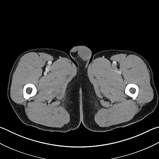 Closed loop small bowel obstruction - internal hernia (Radiopaedia 57806-64778 B 149).jpg
