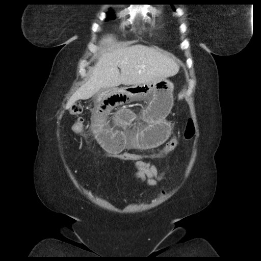 Closed loop small bowel obstruction - internal hernia (Radiopaedia 65402-74450 B 27).jpg