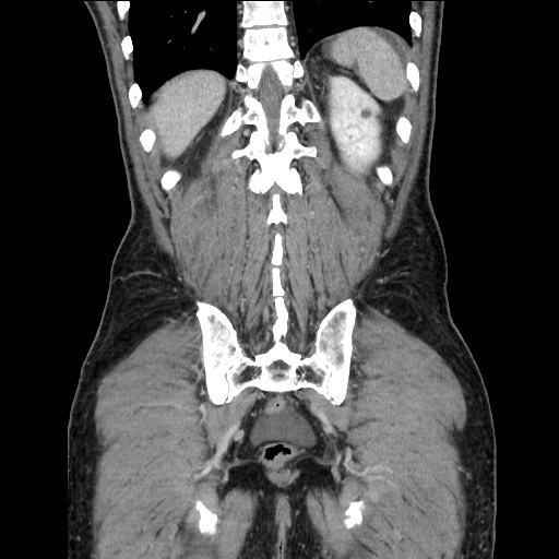 Closed loop small bowel obstruction - omental adhesion causing "internal hernia" (Radiopaedia 85129-100682 B 104).jpg