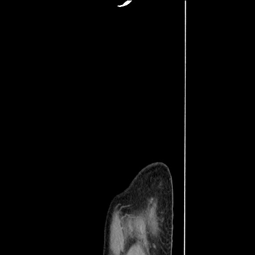 Closed loop small bowel obstruction - omental adhesion causing "internal hernia" (Radiopaedia 85129-100682 C 181).jpg