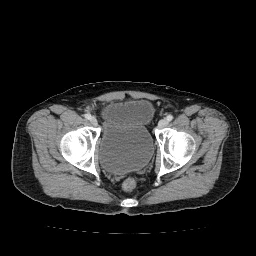 File:Closed loop small bowel obstruction due to adhesive band - U-shaped loop (Radiopaedia 83829-99012 A 65).jpg