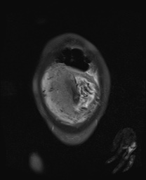File:Closed loop small bowel obstruction in pregnancy (MRI) (Radiopaedia 87637-104031 Coronal T2 fat sat 12).jpg