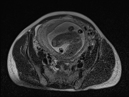 Closed loop small bowel obstruction in pregnancy (MRI) (Radiopaedia 87637-104031 D 22).jpg
