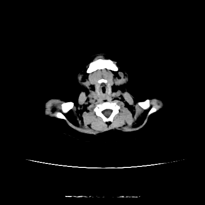 File:Cloverleaf skull (Radiopaedia 91901-109710 Axial non-contrast 18).jpg