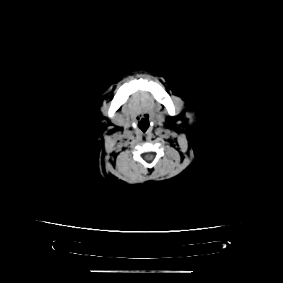 Cloverleaf skull (Radiopaedia 91901-109710 Axial non-contrast 25).jpg