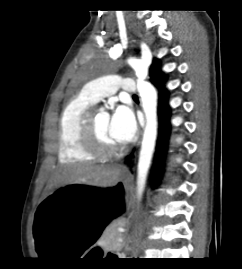 File:Coarctation of aorta (Radiopaedia 27427-27622 Sagittal C+ CTPA 78).png
