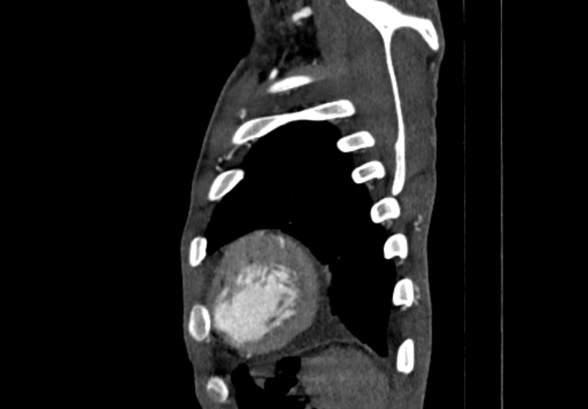 Coarctation of aorta with aortic valve stenosis (Radiopaedia 70463-80574 B 218).jpg