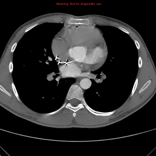 File:Coarctation of the aorta (Radiopaedia 9434-10118 A 105).jpg