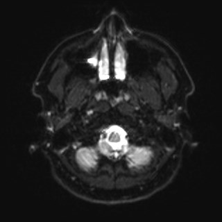 File:Cochlear incomplete partition type III associated with hypothalamic hamartoma (Radiopaedia 88756-105498 Axial DWI 3).jpg