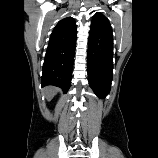 File:Codominant double aortic arch (Radiopaedia 56012-62637 B 38).jpg