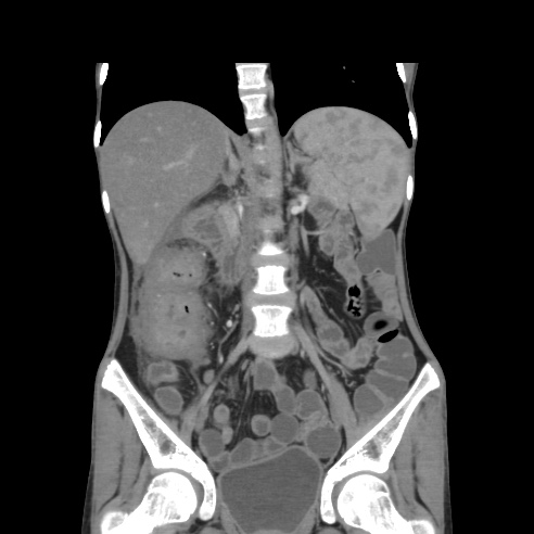 File:Colocolic fistula - Crohn disease (Radiopaedia 57063-63955 B 23).jpg