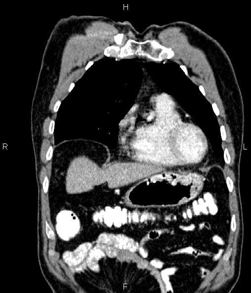 Colon adenocarcinoma (Radiopaedia 83266-97671 C 16).jpg