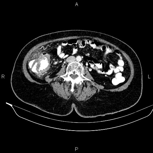 Colon adenocarcinoma (Radiopaedia 91240-108842 A 51).jpg