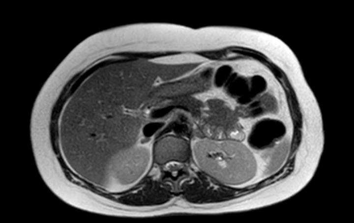 Colon adenocarcinoma with Krukenberg tumors, advanced pregnancy (Radiopaedia 67279-76645 Axial T2 60).jpg