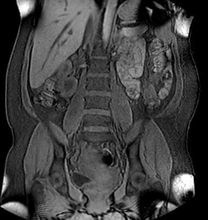 Colon adenocarcinoma with Krukenberg tumors, advanced pregnancy (Radiopaedia 67279-76645 E 57).jpg