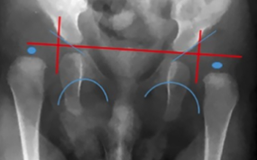 X-ray- dislocation of hips