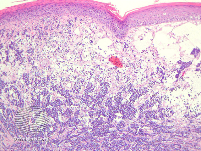 File:Figure 2 (DermNet NZ pathology-e-merkel-cell-carcinoma-figure-2).jpg