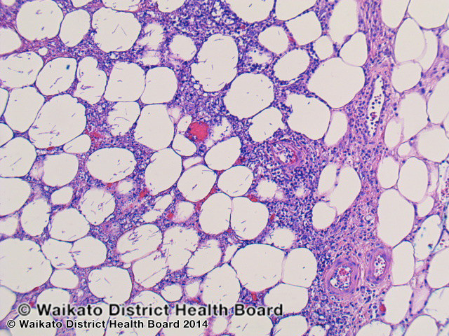File:Figure 3 (DermNet NZ pathology-w-aspergillus-fig-3).jpg