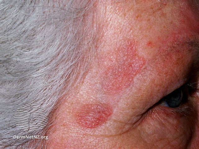 File:Granuloma faciale (DermNet NZ vascular-granuloma-faciale4).jpg