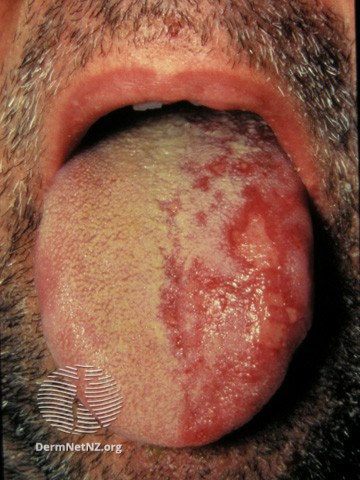 File:Herpes zoster (DermNet NZ viral-zoster-07).jpg